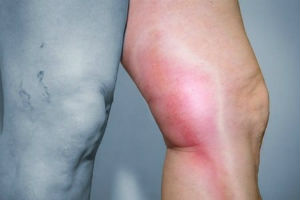 Что такое и как лечить воспаление (тромбофлебит) глубоких и поверхностных вен на ногах