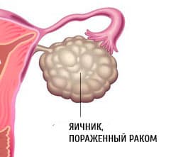 Болит правая сторона яичников. Болезненность яичников. Дискомфорт в левом яичнике.
