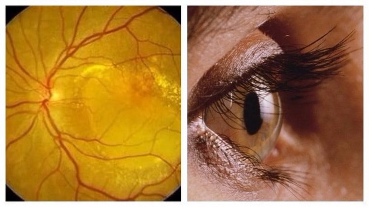 Макулодистрофия сетчатки глаза: причины, симптомы и лечение народными средствами в домашних условиях