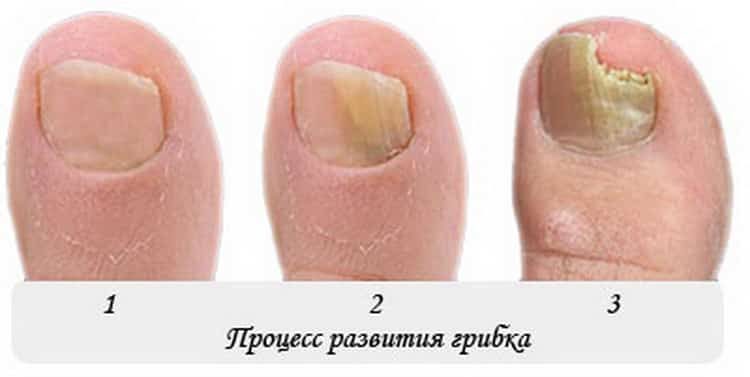 онихомикоз ногтей лечение