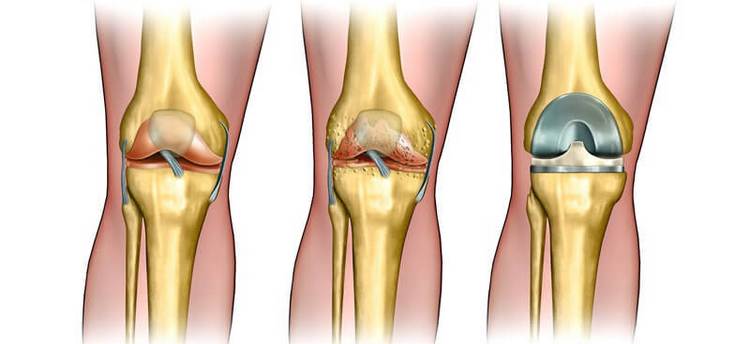 Узнайте все о лечении гонартроза коленного сустава народными средствами.