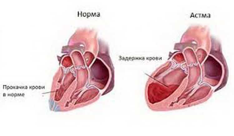сердечная астма симптомы и лечение