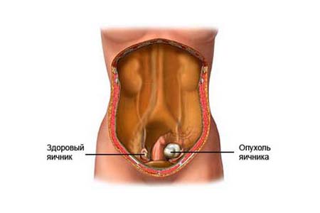 Наличие фиброза в брюшной полости женщины