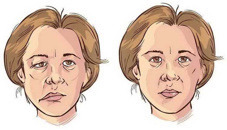 воспаление лицевого нерва симптом