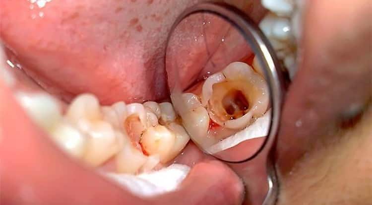 Пульпит зуба: причины, симптомы и лечение народными средствами в домашних условиях