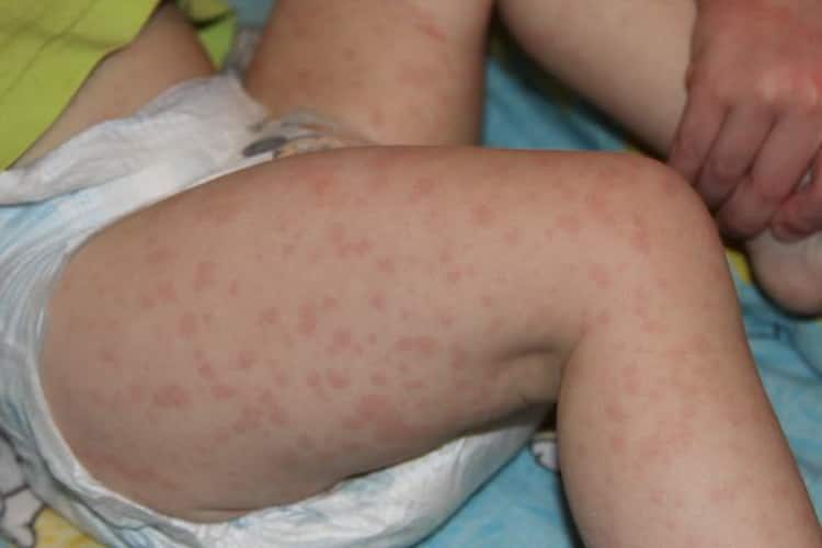 Инфекционный мононуклеоз у детей: симптомы и лечение народными средствами в домашних условиях