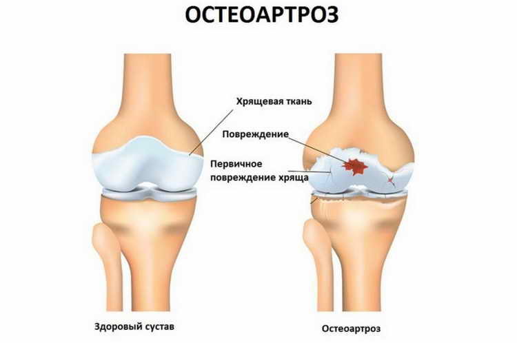 деформирующий остеоартроз коленного сустава 2 степени