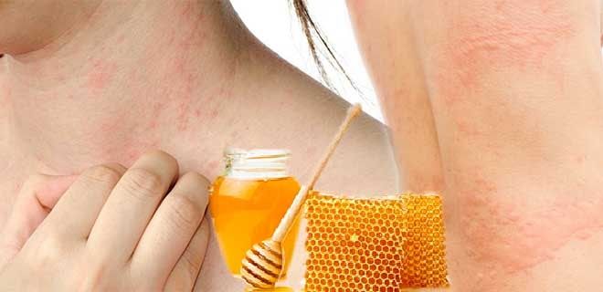 Причины аллергии на мёд