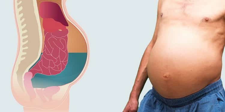 Все о причинах, симптомах и лечении асцита брюшной полости