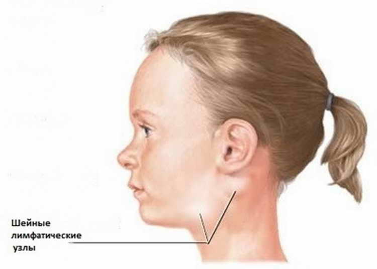 воспаление лимфоузлов на шее у ребенка причины