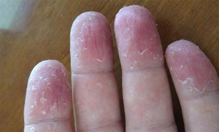 Лечение трещин на пальцах нужно начинать как можно раньше, пока они не стали слишком глубокими.