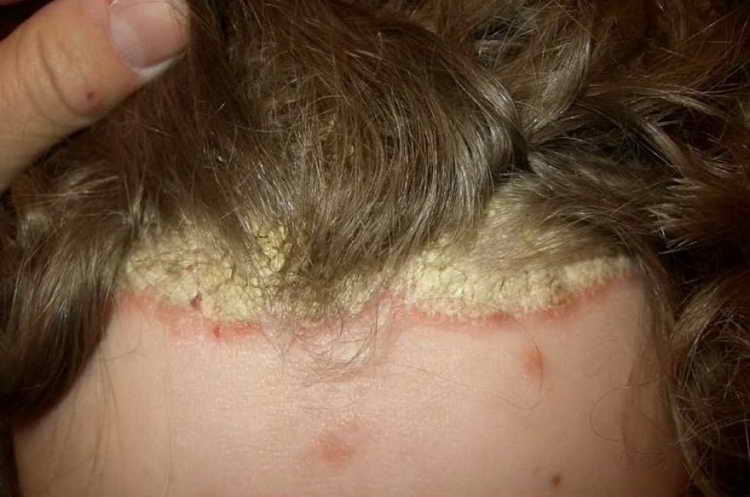 псориаз волосистой части головы лечение