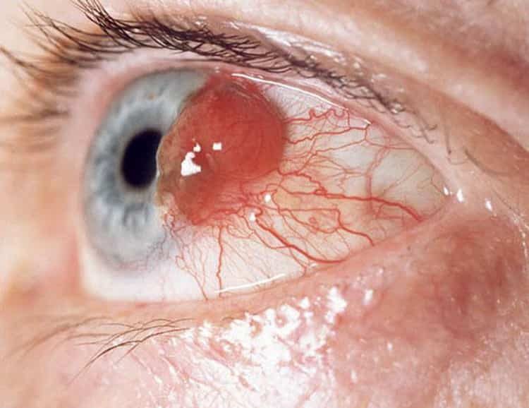 Описание всех глазных болезней, а также их симптомы и лечение