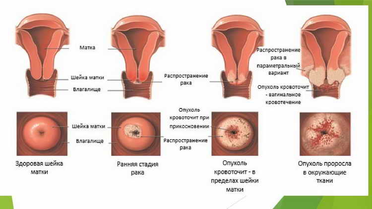 Симптомы проявления заболевания впч у женщин
