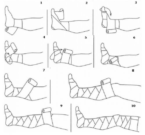 Как правильно бинтовать ногу при варикозе эластичным бинтом