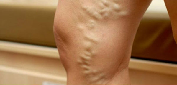 варикоз у женщин на ногах фото