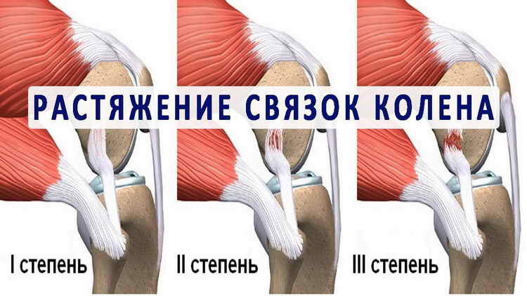 растяжение связок коленного сустава