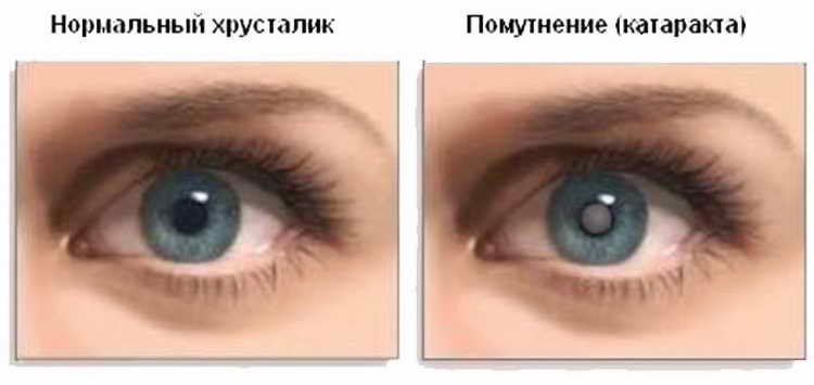 глаукома симптомы