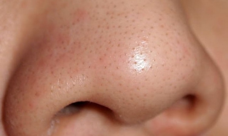 Черные точки на носу и подбородке более характерны для жирного типа кожи.