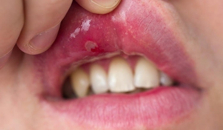 Лечение язвочек во рту нужно начинать при появлении самых первых симптомов.