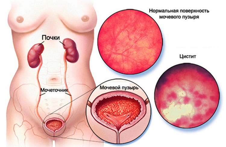 так выглядит воспаление мочевого пузыря у женщин.