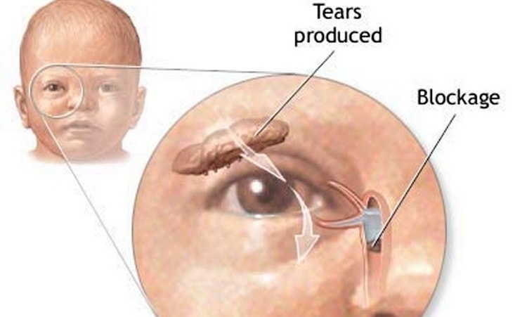 При дакриоцистите у ребенка закупоривается носослезный канал.