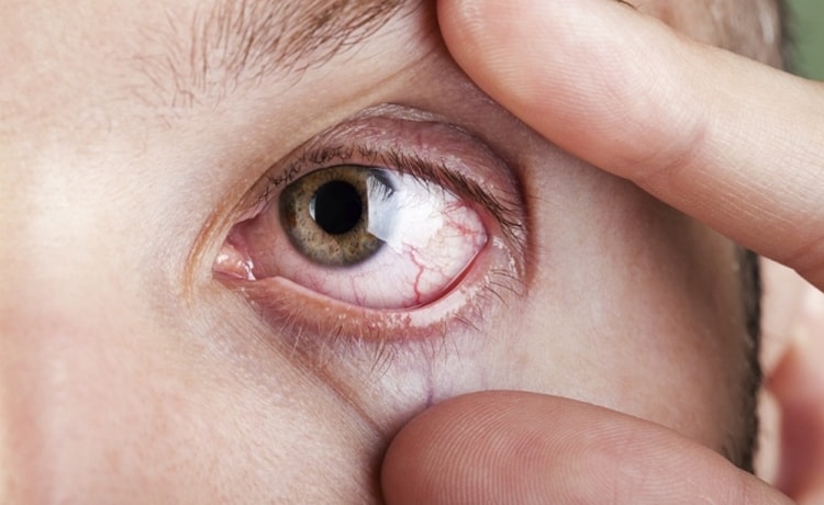 Очень важно вовремя начать лечить синдром сухости глаз, чтобы избежать осложнений.