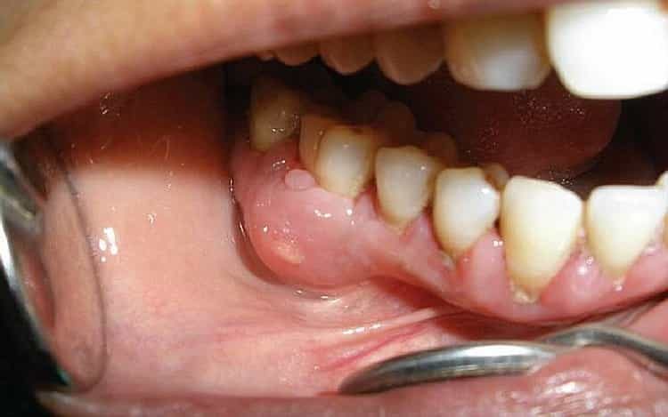 лечении воспаления надкостницы зуба