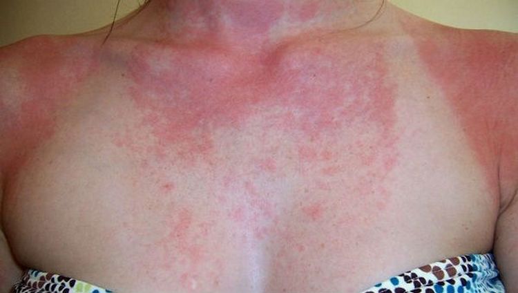 На фото видны симптомы аллергии на солнце, требующие лечения.