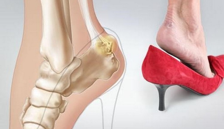 Спровоцировать заболевание могут сильные нагрузки на ноги, неправильно подобранная и неудобная обувь.