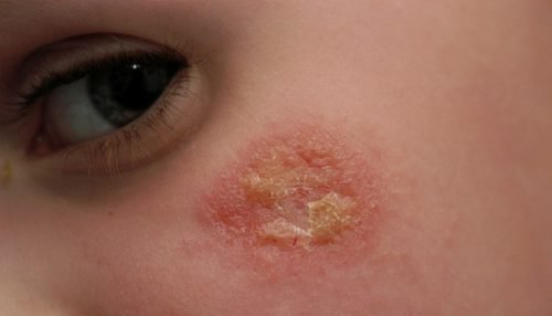 Мокнущий дерматит у детей