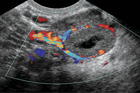 Ультразвуковая диагностика яичника и лютеиновое тело