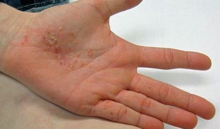 Лечение дисгидроза кистей рук можно проводить в домашних условиях.
