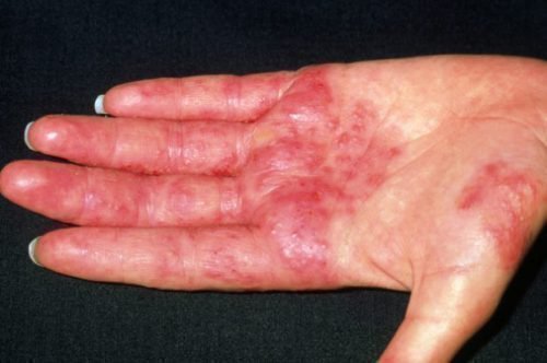 Рука с дерматитом