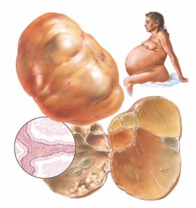 Муцинозное образование яичника у женщины