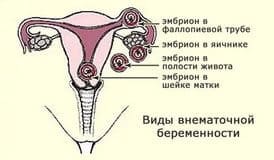 Внематочное зачатие (патология)