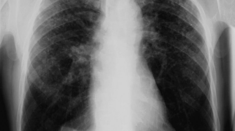 Симптомы силикоза легких хорошо видны на рентгеновских снимках.