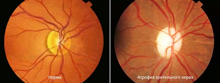 Так выглядит атрофия зрительного нерва при осмотре офтальмологом.