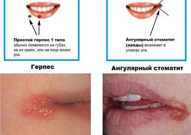 трещины в уголках губ причины и лечение