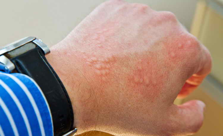 холодовая аллергия симптомы и лечение