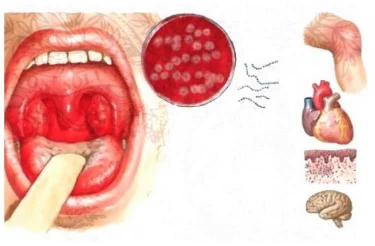 Стрептококковая инфекция в горле: причины, симптомы и лечение народными средствами в домашних условиях