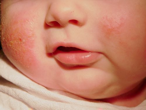Аллергический дерматит у детей