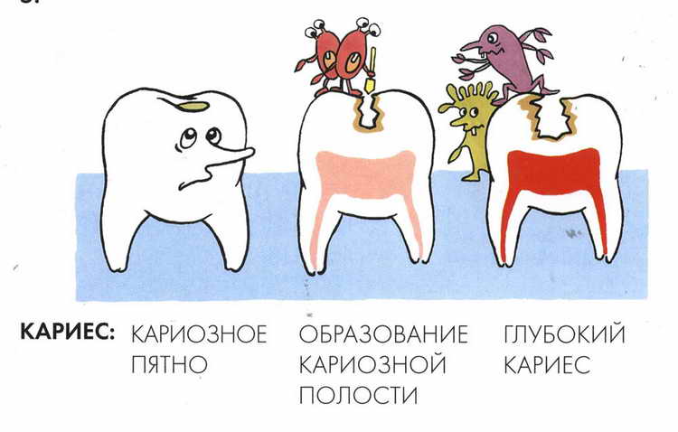 лечение кариеса зубов быстрое