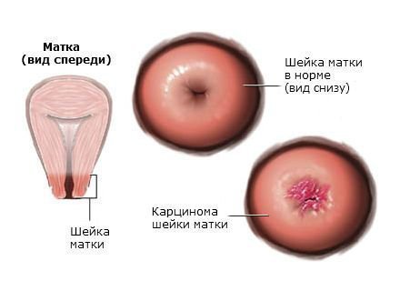 Аденокарцинома шейки матки