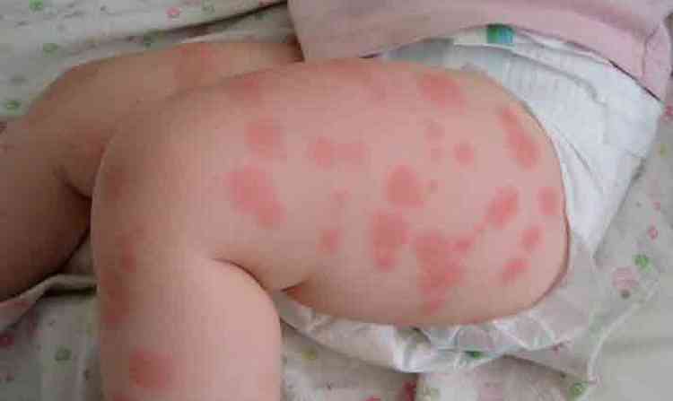 на фото видны симптомы аллергии у ребенка, требующие лечения.