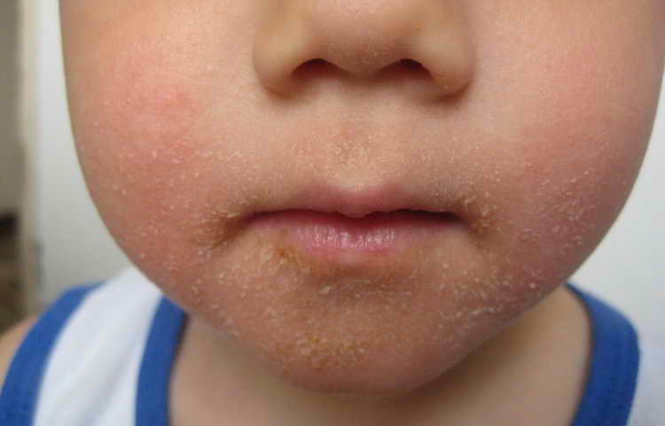 ротавирусная инфекция у детей лечение комаровский