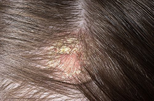 Лечение себорейного дерматита кожи головы дегтярным мылом thumbnail