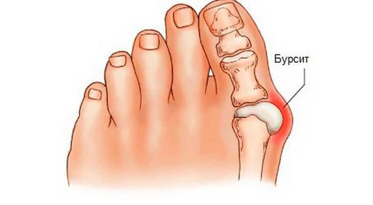 косточка на большом пальце ноги лечение