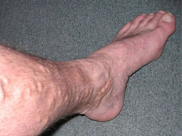 варикоз у мужчин на ногах фото